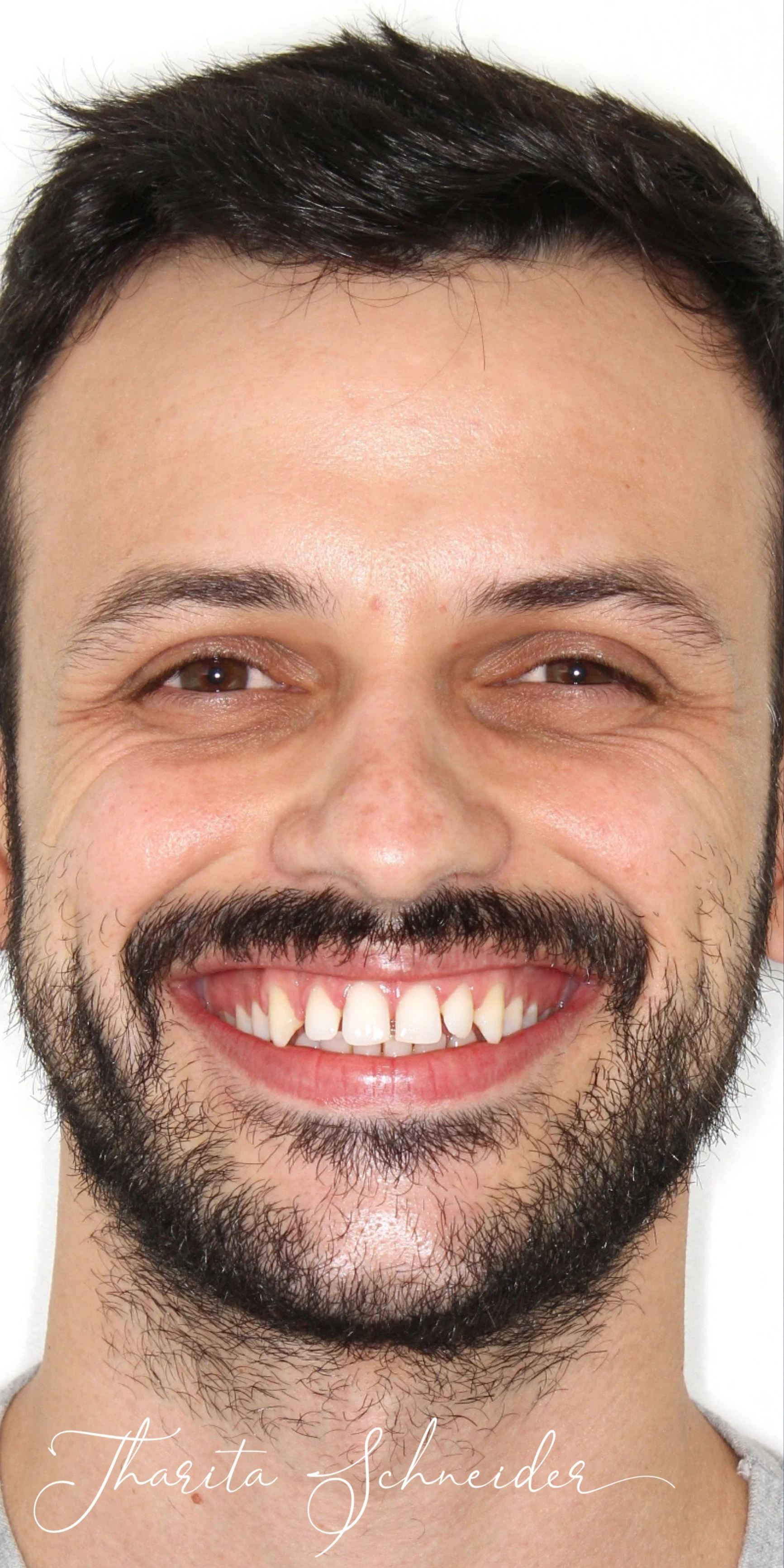 Antes — Botox + Alinhadores + Clareamento + Facetas de Resina