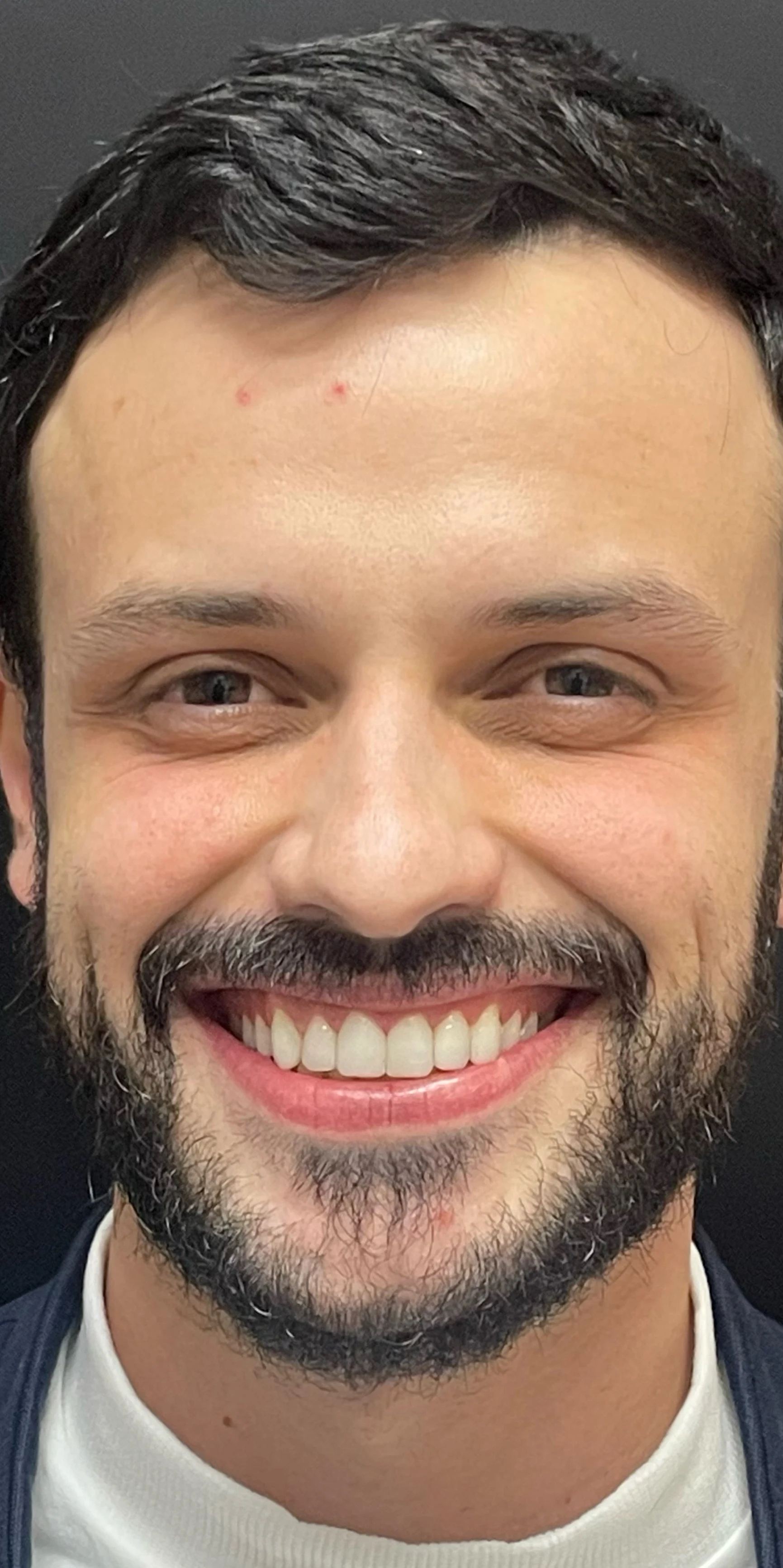 Depois — Botox + Alinhadores + Clareamento + Facetas de Resina