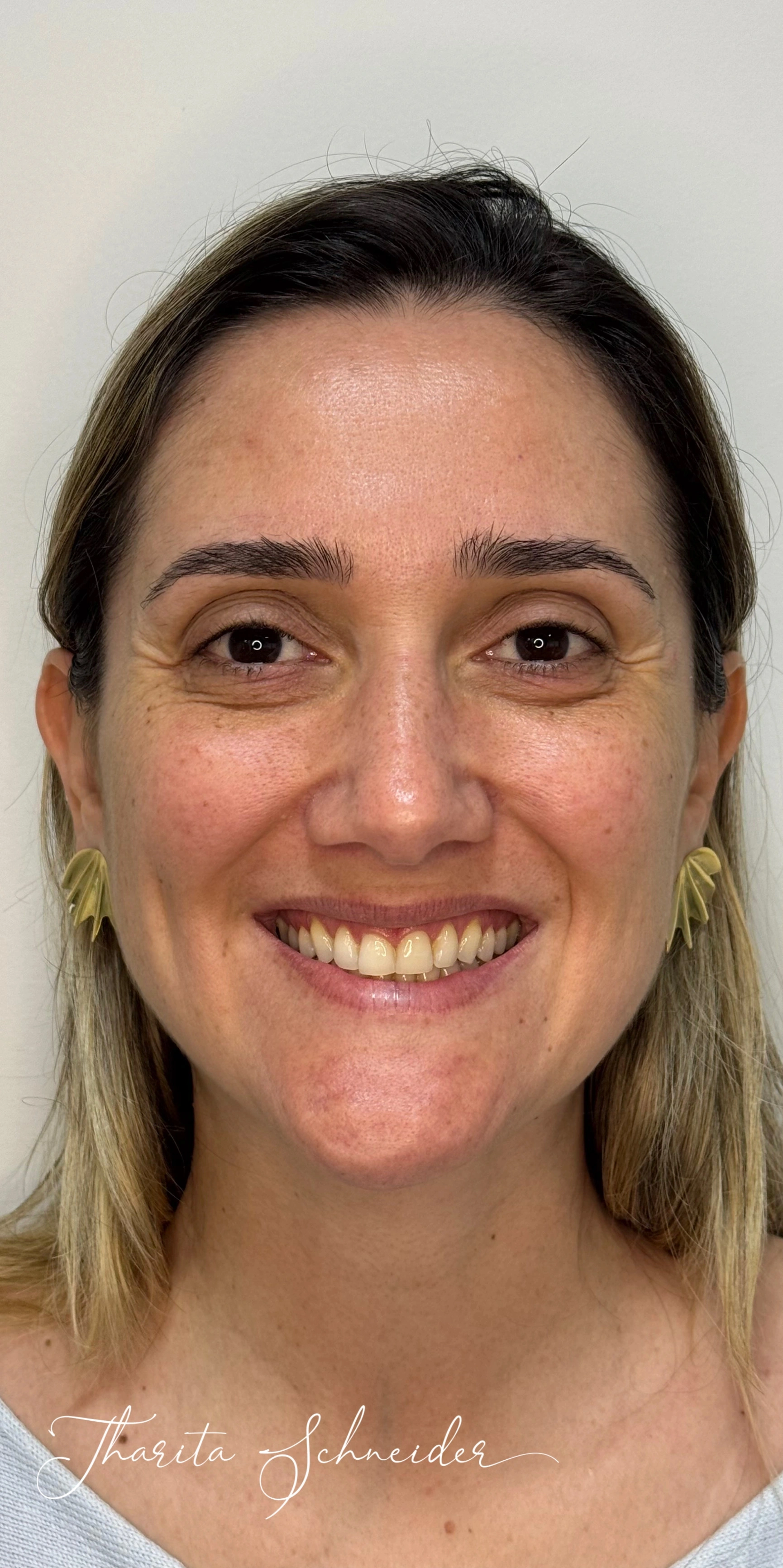 Antes — Botox + Estética Regenerativa de Pele