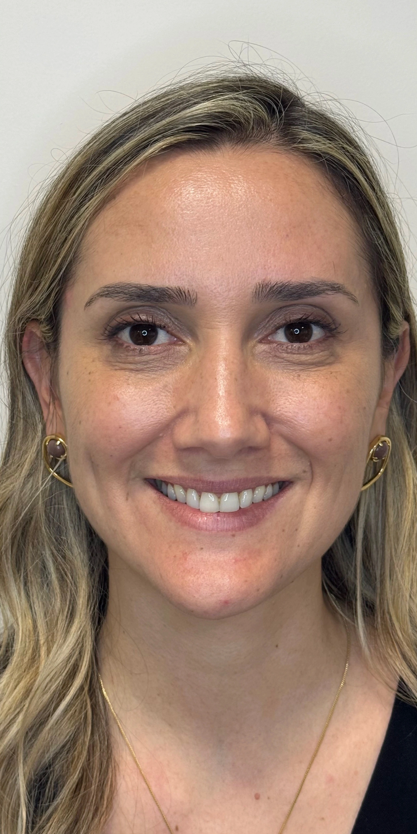 Depois — Botox + Estética Regenerativa de Pele