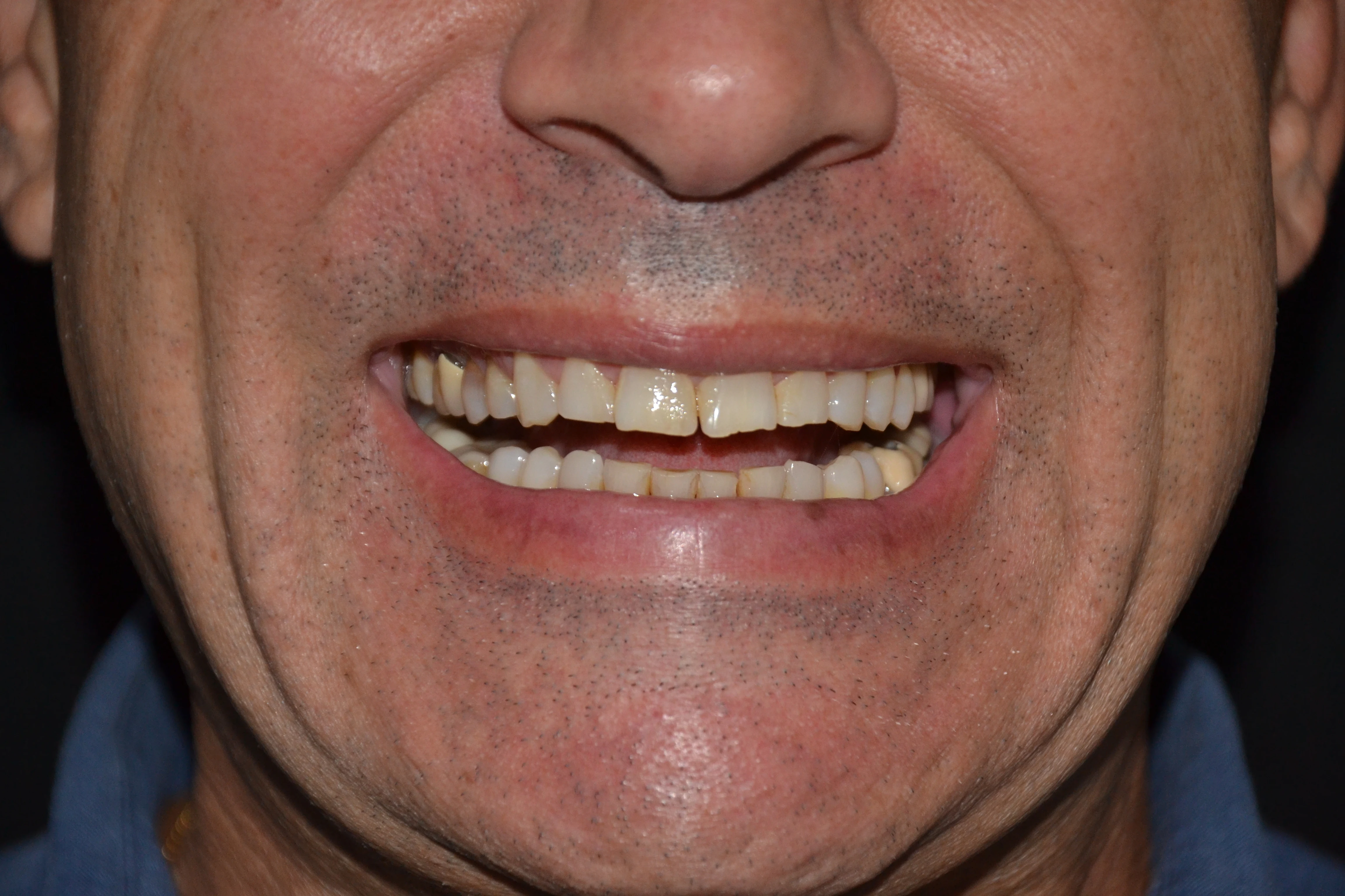 Antes — Lentes de Contato Porcelana