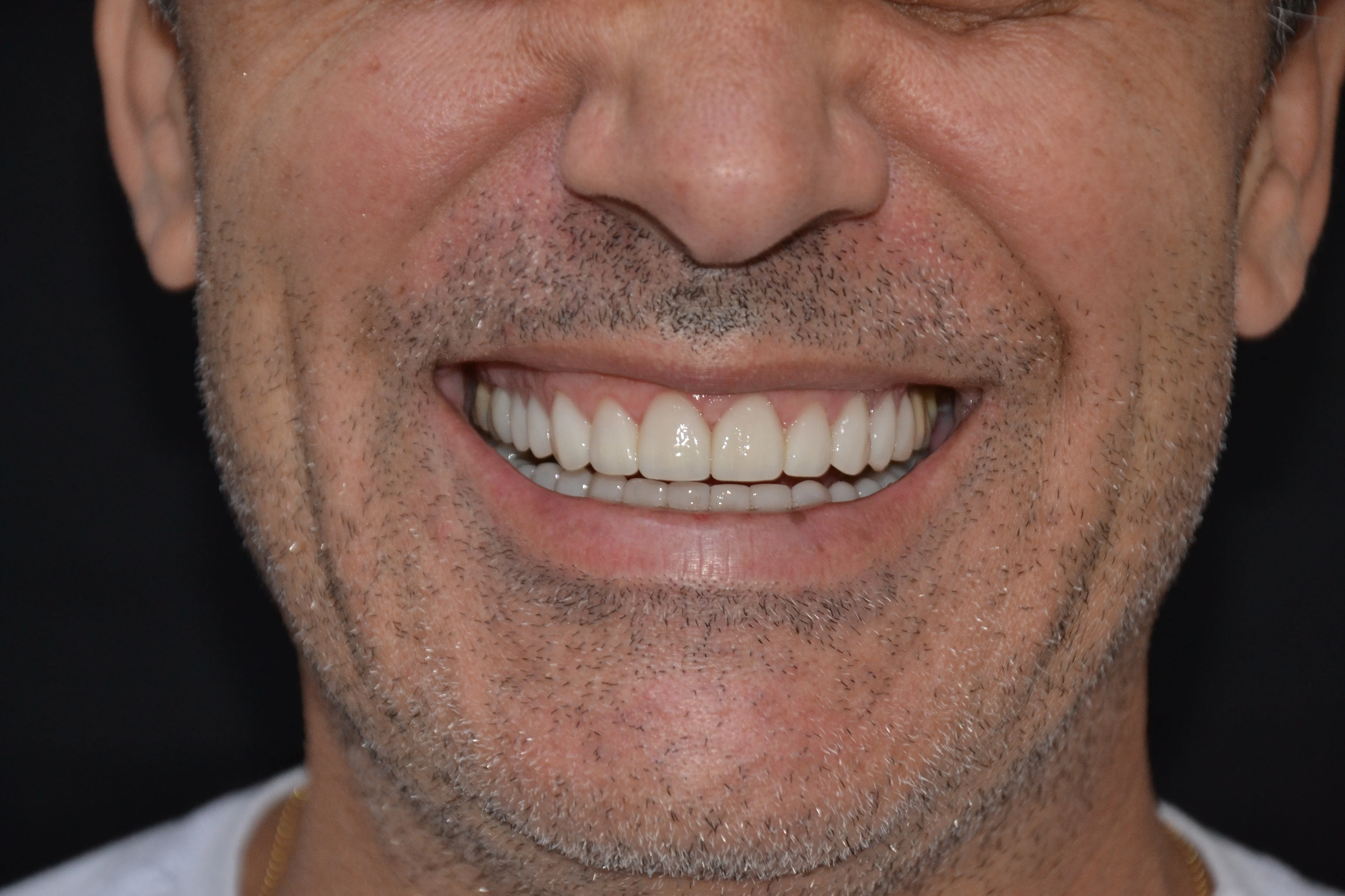 Depois — Lentes de Contato Porcelana