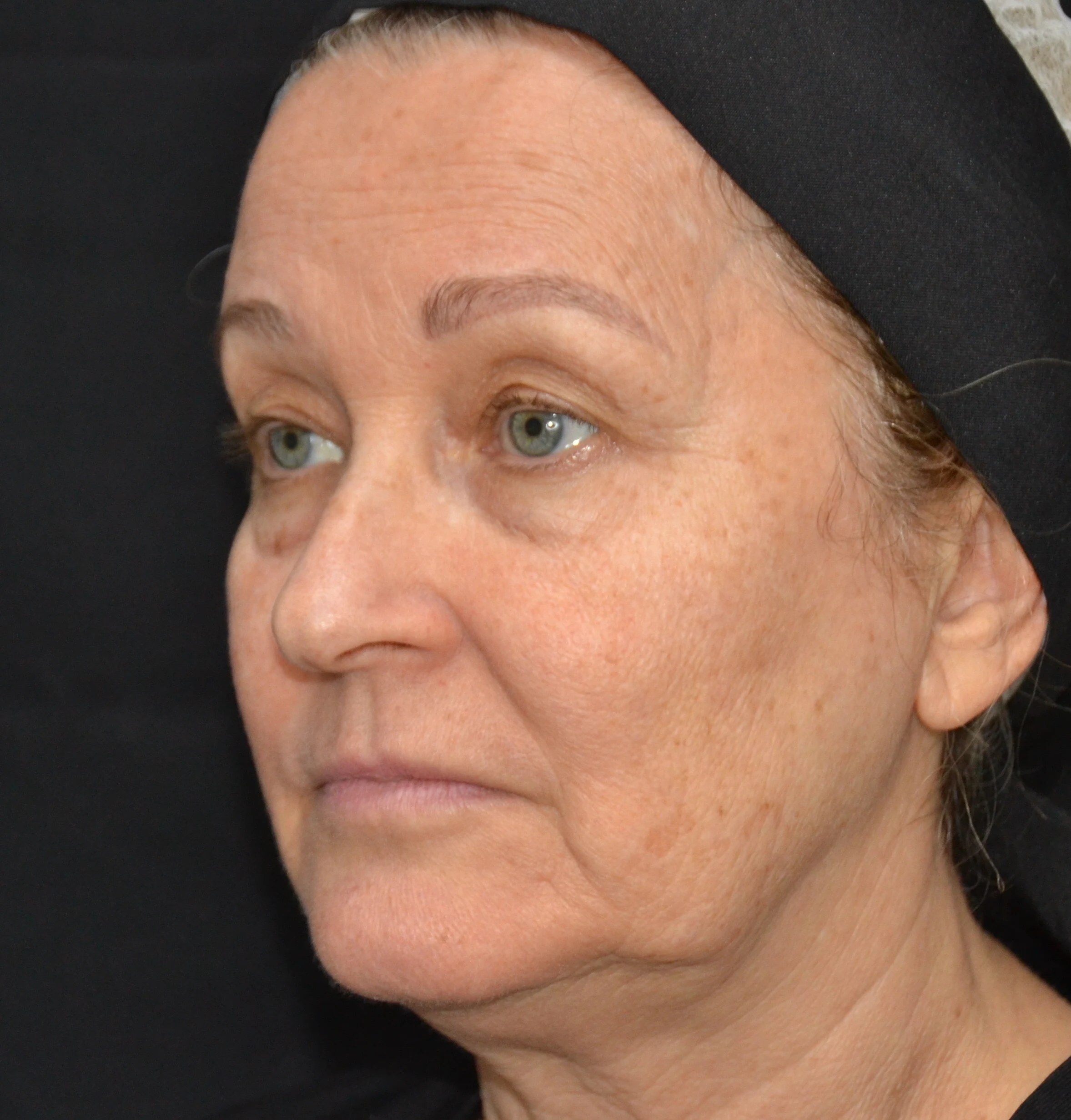 Antes — Preenchimento Full Face + Fios de Tração