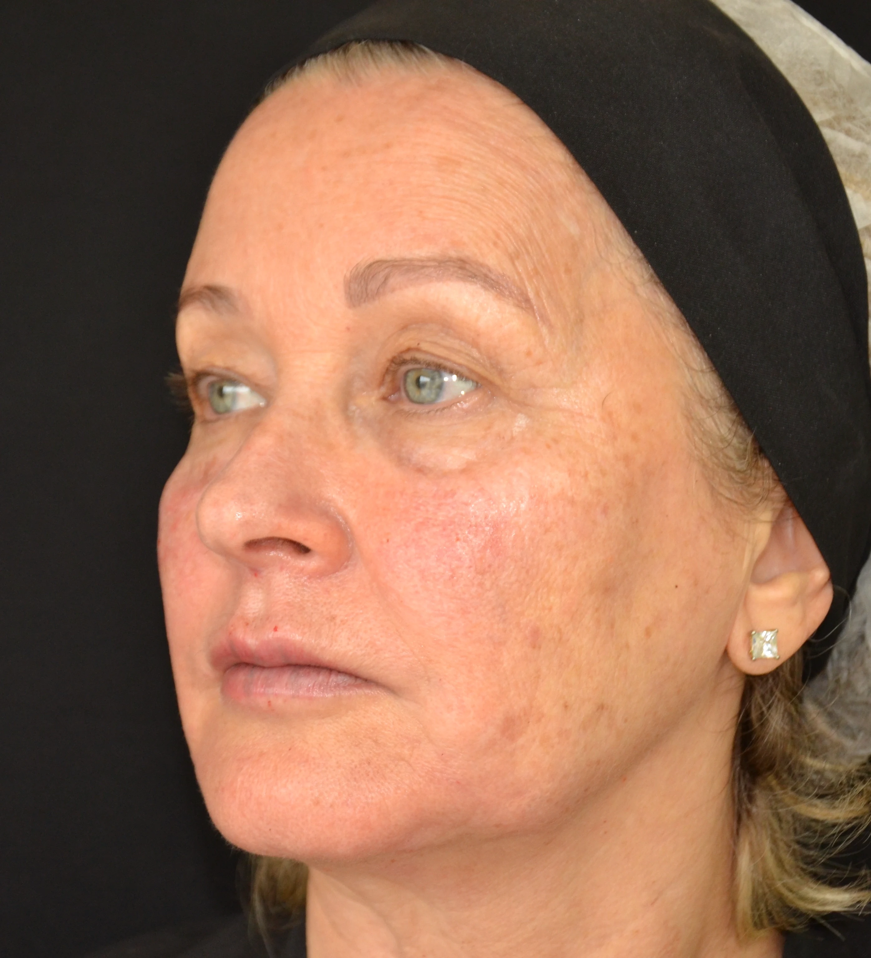 Depois — Preenchimento Full Face + Fios de Tração